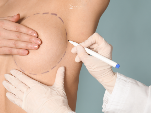 由腋下、乳房下緣或乳手術切口評估 依個人解剖條件、植體規格及手術需求，評估合適的切口位置，例如乳房下緣或其他適用方式暈周圍建立切口。