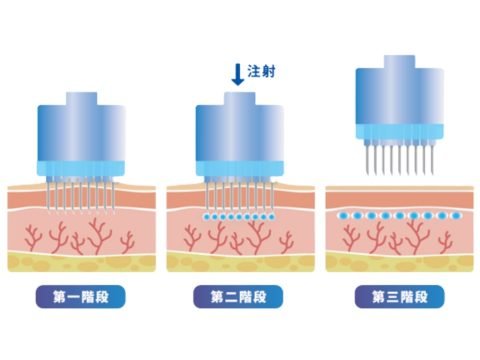 分區進行注射  使用 HYCOOX 電動注射系統，依規劃範圍分區施作，透過多針座設計與負壓輔助，協助醫師進行規律的注射操作；實際注射位置與方式須依產品核准用途及醫師評估決定